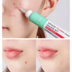 NUMBUZIN – No.2 Miracle Trouble Care Double Kit | Anti-Acne - Image 4