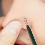 PYUNKANG YUL – Pimple Extractor Set | Blackhead Removal - Image 3