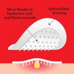 CURESYS – Trouble Clear Needle Patch | Acne Treatment Patch - Image 2