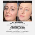 MEDICUBE – Red Acne Succinic Acid Peel | Calming Exfoliant - Image 4