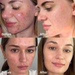 MEDICUBE – Red Succinic Acid Serum | Acne Treatment - Image 4